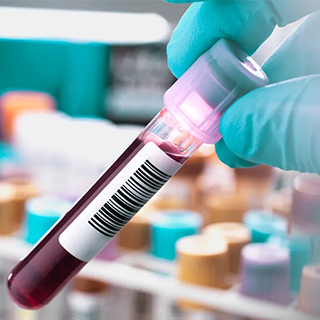 ANTI B2 GLYCOPROTEIN IgM